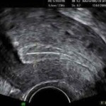 predicting uterine weight from ultrasound measurements