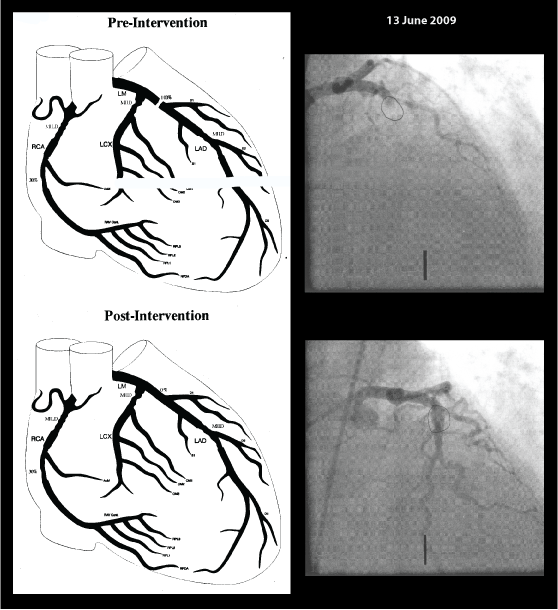 Dad-Heart-Cath-20090613
